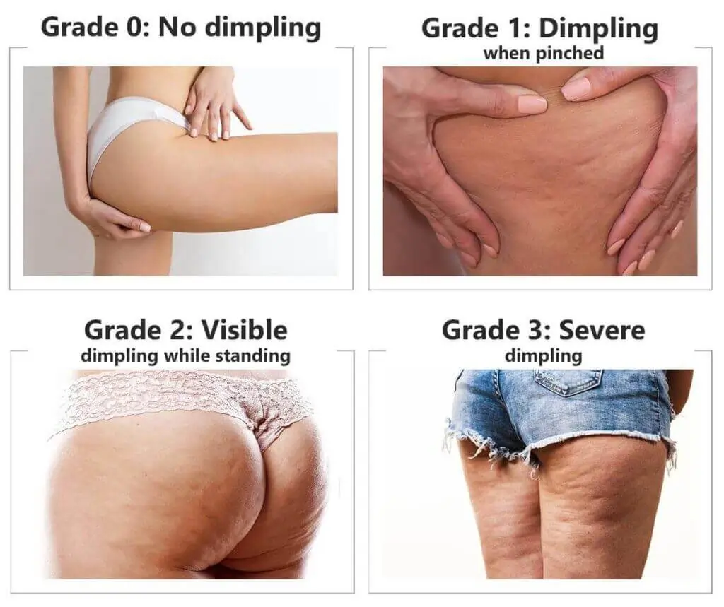 Representation of the stages of cellulite development Woking